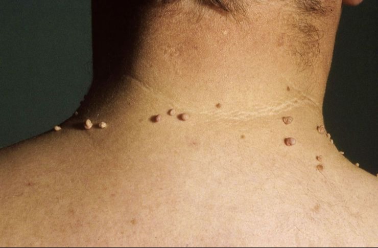 A végbélrák 7 jele, amiről sokan nem tudnak